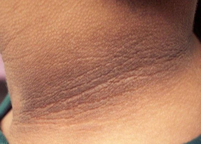 Bệnh Acanthosis nigricans