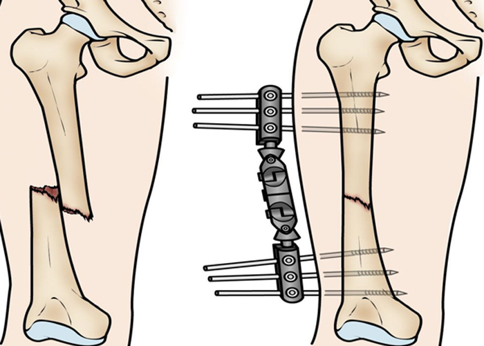 Việc chữa lành gãy xương bình thường của con người bao gồm ba giai đoạn: viêm, sửa chữa và tái tạo.