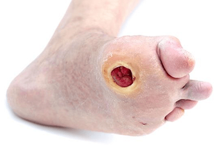 Hình ảnh bàn chân bị loét của bệnh nhân tiểu đường
