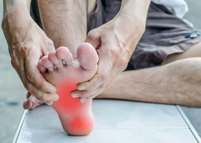 Bệnh thần kinh ngoại biên có thể gây biến chứng bàn chân