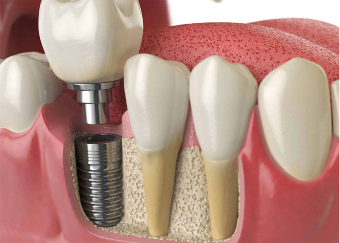 Phương pháp cấy ghép răng vào xương hàm giúp bệnh nhân có thể phục hình răng bị mất.