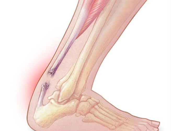Tổn thương gân bàn chân thường gặp