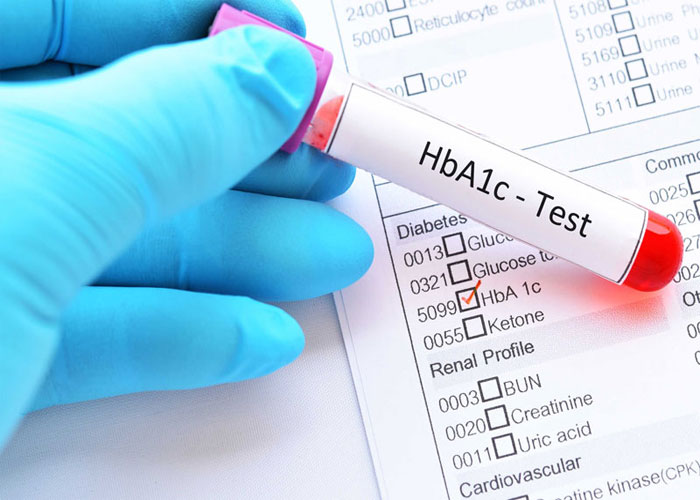 Xét nghiệm HbA1c để chẩn đoán bệnh