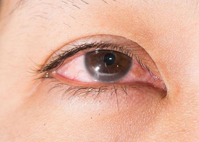 Bệnh nhân tiểu đường có thể có nhiều biến chứng về mắt